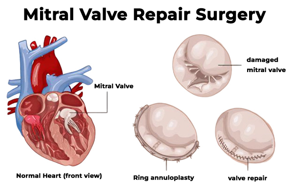 Valve Repair and Replacement