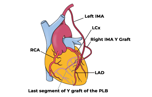 Coronary Bypass Procedures