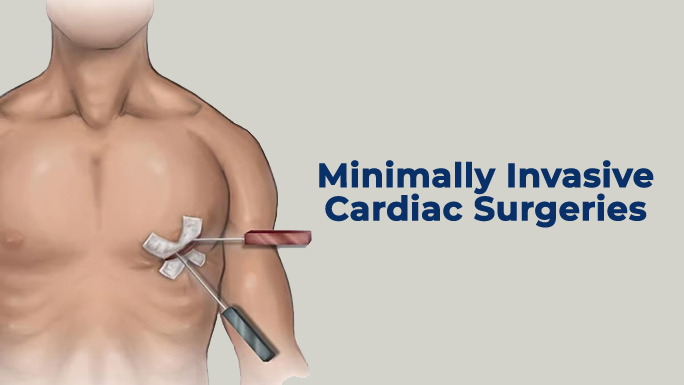Minimally Invasive Keyhole Cardiac Surgery
