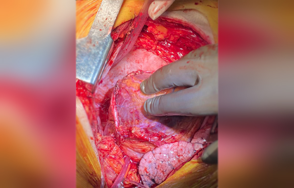 Total Arterial Revascularization