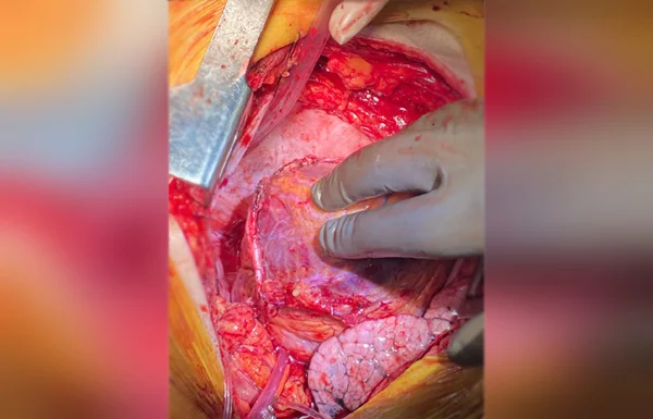 Total Arterial Revascularization