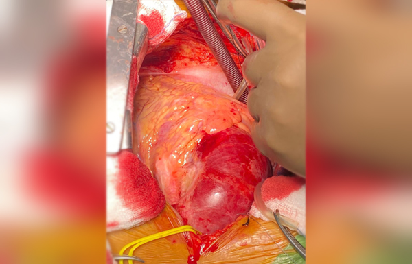 Aortic Aneurysm Surgery