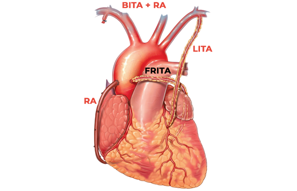 Total and Multiple Arterial Revascularization