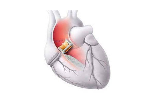 Valvular Heart Surgery