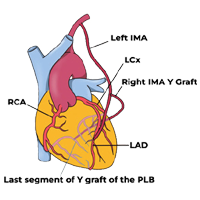 Coronary Artery Bypass Surgery
