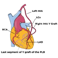Coronary Artery Bypass Surgery