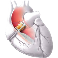 Valvular Heart Surgery