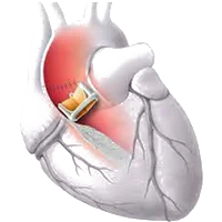 Valvular Heart Surgery