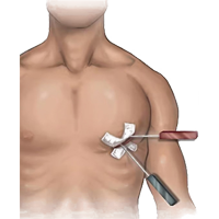 Minimal Invasive Cardiac Surgery