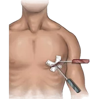 Minimal Invasive Cardiac Surgery