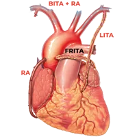 Total and Multiple Arterial Revascularization